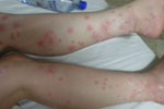 Eliminate Bed Bugs with Natural Bed Bug Formula Guaranteed Effective and Safe for Sarasota, Florida